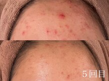 ホワイトアクア 天王寺本店(WHITE AQUA)/ハーブピーリング/毛穴/天王寺