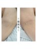 高出力でしっかり効果がでる☆お試し1回☆《脇脱毛》