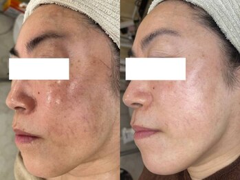 エヴェリーナ(Eveliiina)/シミケア&肌質改善でツヤツヤ肌