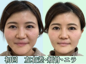 ナチュラルパーフェクトフェイス 新宿/２０代初回／小顔造顔新宿