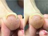 【フット】痛い巻き爪を優しく補正！巻き爪補正1箇所¥6600