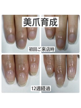 マニュコクーン(ManuCocoon)/爪育成 深爪 巻き爪 大阪市