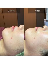 マリー(Mary.)/ハーブピーリング