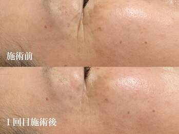 キーオブフェイス(Key of Face)/お悩み【目元のシワ】