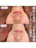 【35歳からの小顔美肌】たるみ×くすみ徹底プラズマリフトコース♪3500円