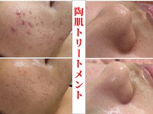 ゆらり/ニキビ・黒ずみケア