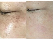 肌に合わせたオーダーメイド施術。シワ軽減。シミが動き出す。