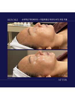 トータルクリア(TOTAL CLEAR)/韓国高級エステ「SUPERJECTION」