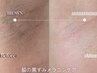 【ルメラx脇】脱毛後あるあるのお悩みケア。隠し脇卒業!夏までに間に合う♪