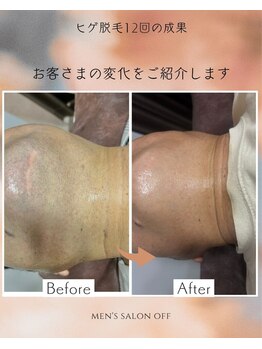 オフ(off)/ヒゲ脱毛