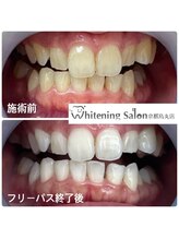 ホワイトニングサロン 京都烏丸店/ホワイトニング施術例