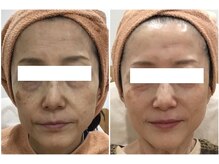 リッツ 草加店(Ritz)/【Before/Afteｒ】たるみ改善