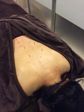 ウェルビープラーカ(Well-beプラーカ)/慢性的な肩こり、腰痛にオススメ