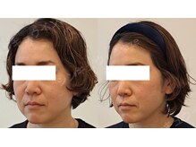 鍼灸院アゼ(AZE)/お顔の変化