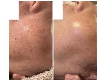 ティアラビューティ/シミケアと美肌へのコース