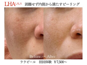 ビクトリー(VICTORY)/韓国肌管理ララピール