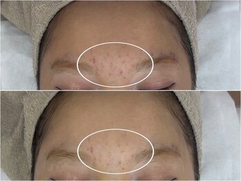 アンリミット 原宿竹下通り店(Une limit)/【頑固な肌荒れに】