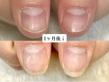 グラシナ なんば店/深爪/自爪育成/フィルイン