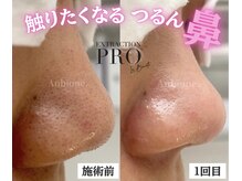 アンビワン(Anbione.)の雰囲気（ハイドラでは届かない、毛穴奥の汚れまで除去する当店の毛穴ケア）