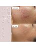【ニキビ/毛穴/黒ずみ】剥離なしハーブピーリング|ダウンタイムなし◎