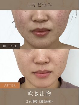 けいのき鍼灸整骨院の写真/【夏の毛穴ケアに！】繰り返す肌悩みに美容鍼！血流UPでニキビ・毛穴をケアし潤う素肌美肌へ♪