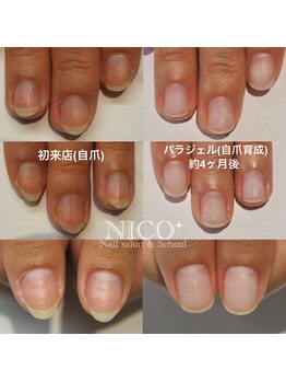 ニコプラス(NICO+)/パラジェルクリア補強