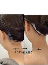 メディカルサロンドオフ 堺東店(medical salon de off)/うなじ＆襟足脱毛