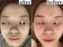 アワピール 成田公津の杜店(AWA PEELL)/ハーブピーリングで赤ら顔改善