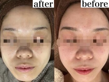 アワピール 成田公津の杜店(AWA PEELL)/ハーブピーリングで赤ら顔改善