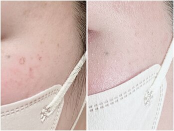 カレンジェビューティー(CarengeBeauty)/プラズマシミケア