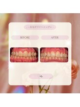プラスビー 2号店(+b)/ホワイトニングビフォーアフター