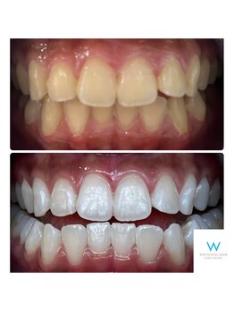 ホワイトニングショップ 奈良生駒店/食事制限なし！