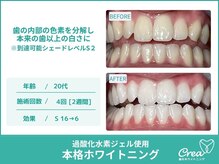 クレア(Crea)/【ホワイトニング症例写真】