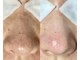 エルナ(elnna)の写真/【30代からの毛穴悩みに】黒ずみ・詰まり・開きをエクストラクションで根本から徹底改善します♪