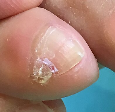 副爪2箇所（小指の爪横にある爪ではないモノ）【魚の目までケア】　\6,600