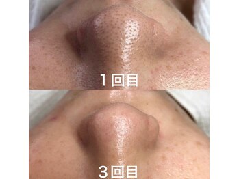 ビューティーネイル(Beauty Nail)/毛穴エクストラクション