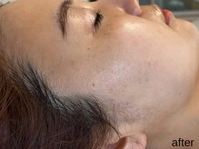 サロン ド エメ(salon de aimer)/【After】シミ速攻分解！