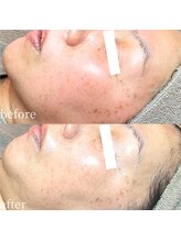 フィエルテ(Fielte)/小顔/ハリ/艶肌