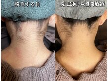 美意識/うなじ脱毛　3500円