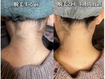 美意識/うなじ脱毛　3500円