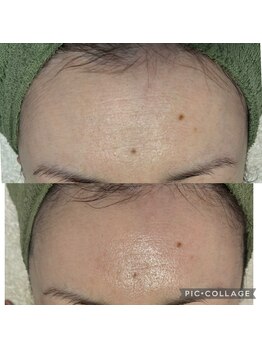 ラズ(Luz)/雪花ピール１回の施術直後