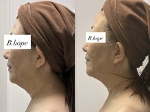 ビーホープ(B.hope)/60代モニター様1回目