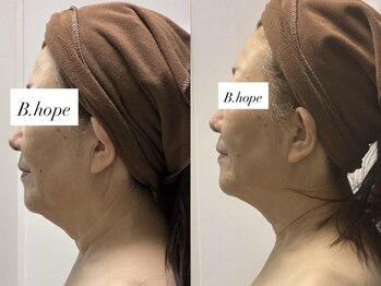 ビーホープ(B.hope)/60代モニター様1回目