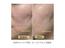 トワヒーリング(toihealing)/肌質改善/VOSサロンケア