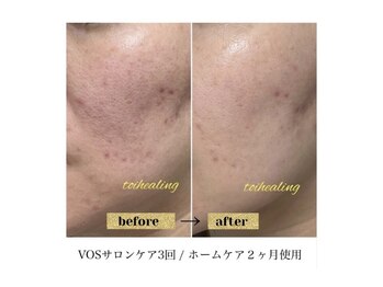 トワヒーリング(toihealing)/肌質改善/VOSサロンケア