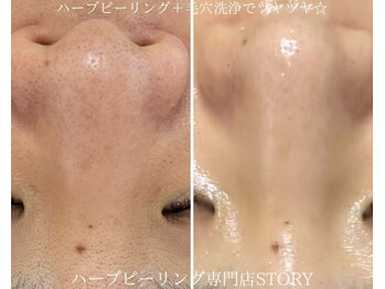 ストーリー(STORY)/ハーブピーリング専門店STORY