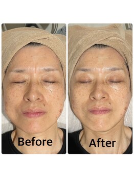 バブル(BUBRU)/光フェイシャル2回の効果