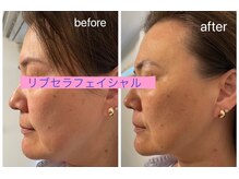 プリュネル(Prunelle)/プラズマシャワー