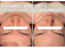 ミエル 神戸店(Miel)の雰囲気（レストトリートメントで鎮静◎ニキビケアに！初回体験¥8,800）