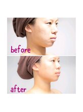 サットサンガ 表参道(SatSangah)/小顔コース　60分/before after